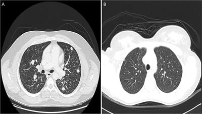 Predictive risk factors for distant metastasis in pediatric differentiated thyroid cancer from Saudi Arabia